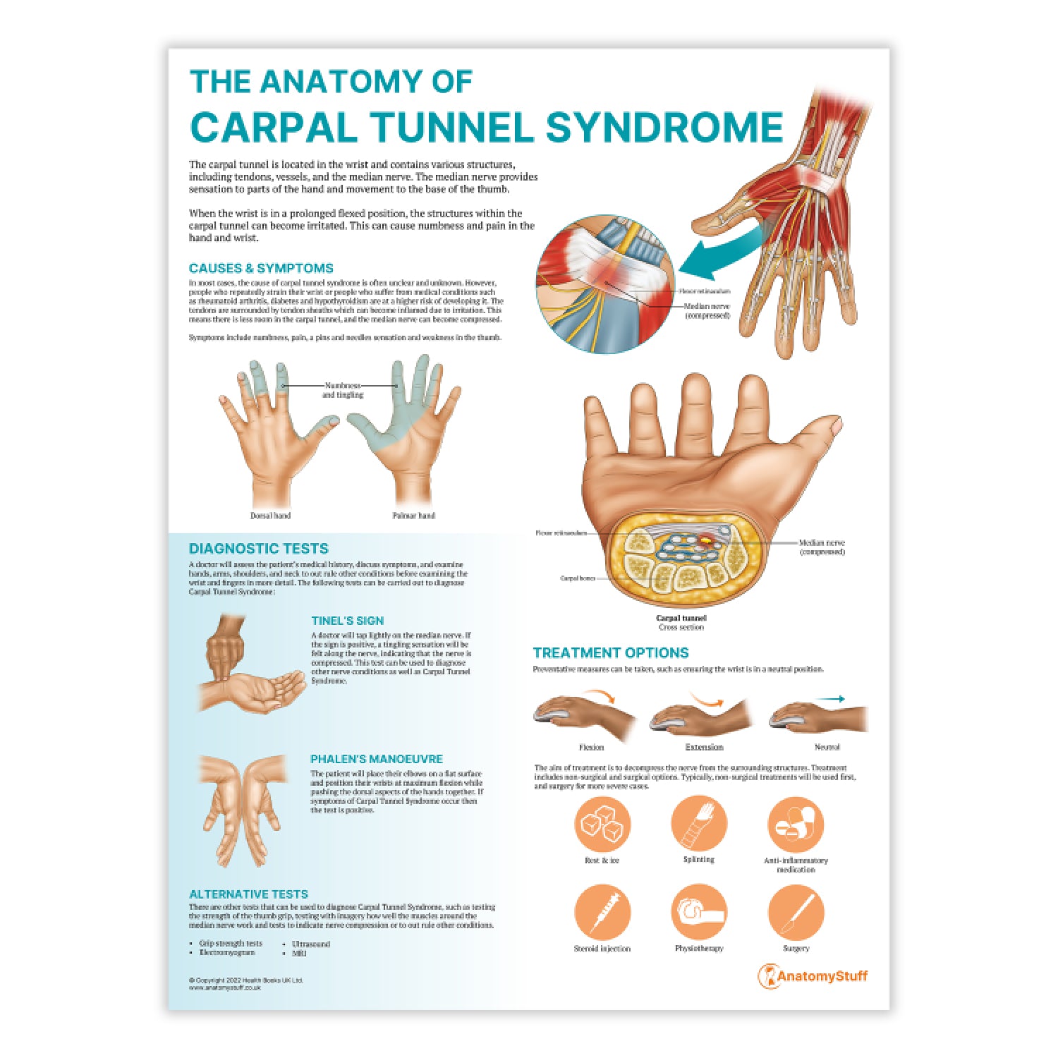 The Anatomy of Carpal Tunnel Syndrome Chart / Poster