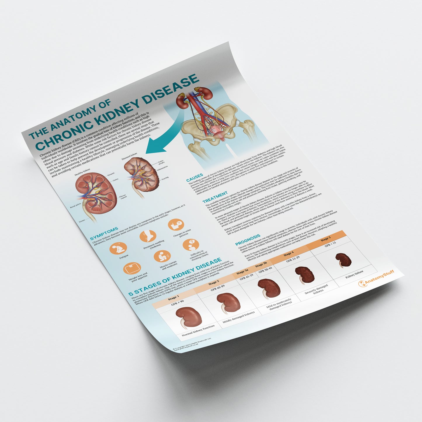 The Anatomy of Chronic Kidney Disease Chart / Poster