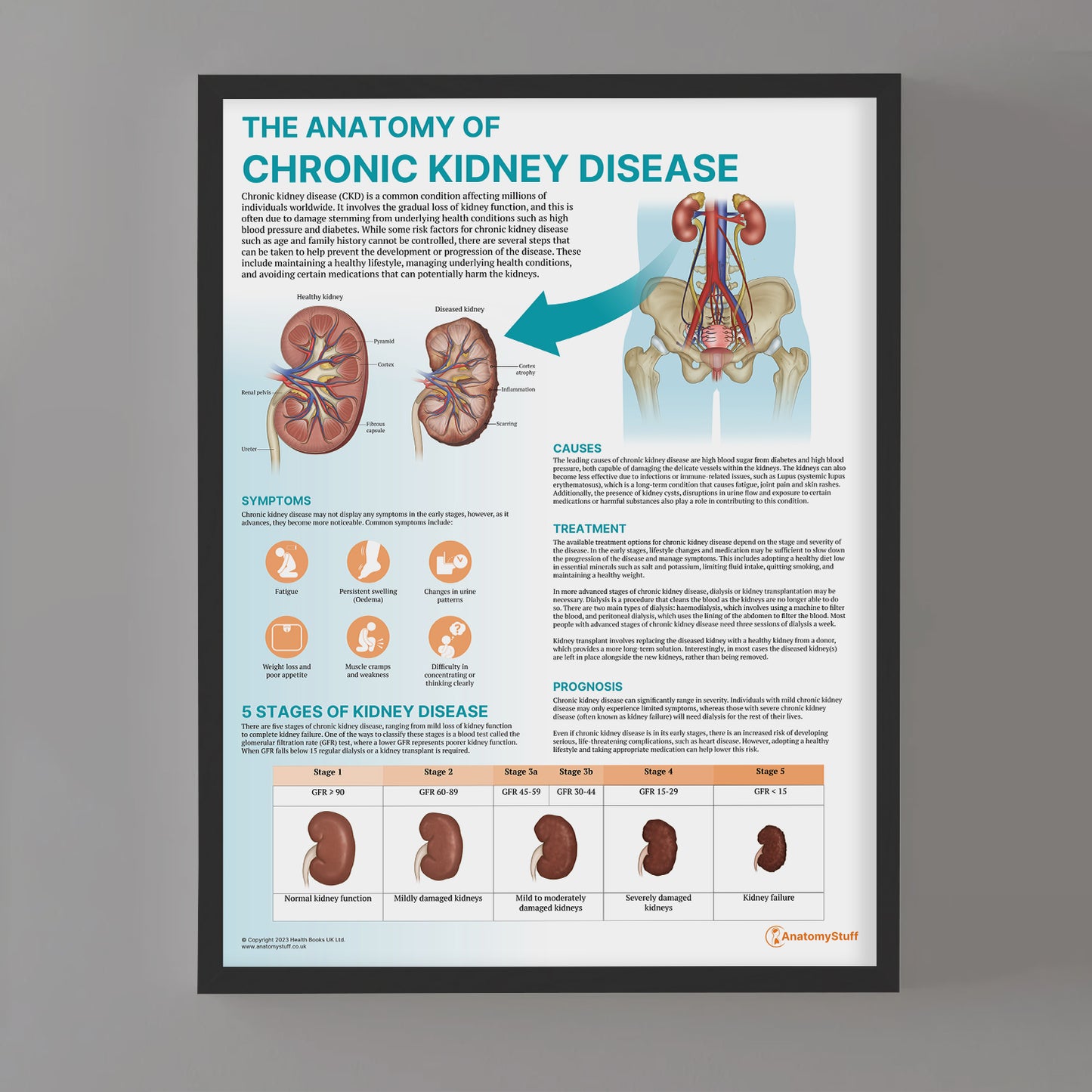 The Anatomy of Chronic Kidney Disease Chart / Poster