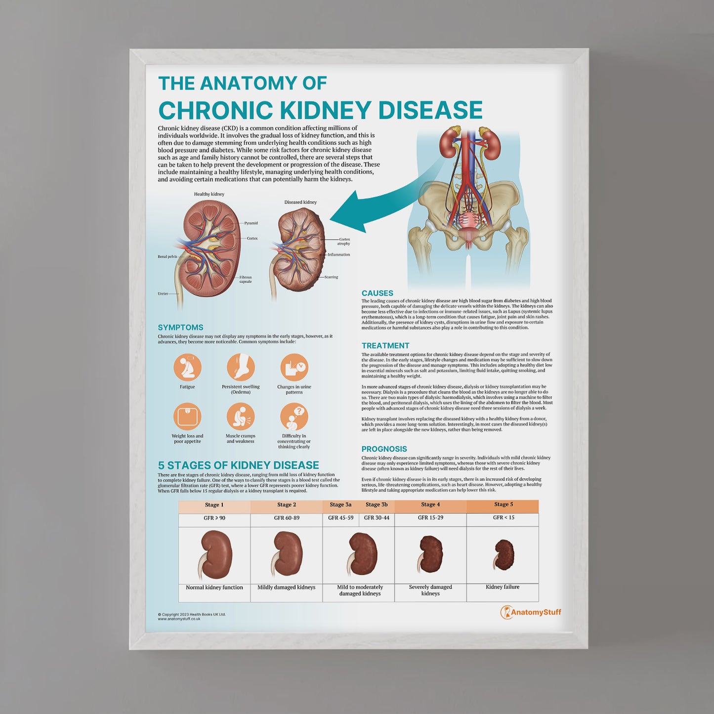 The Anatomy of Chronic Kidney Disease Chart / Poster