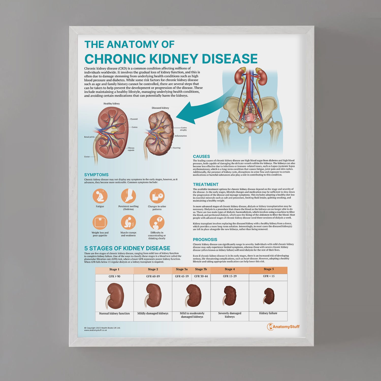 The Anatomy of Chronic Kidney Disease Chart / Poster