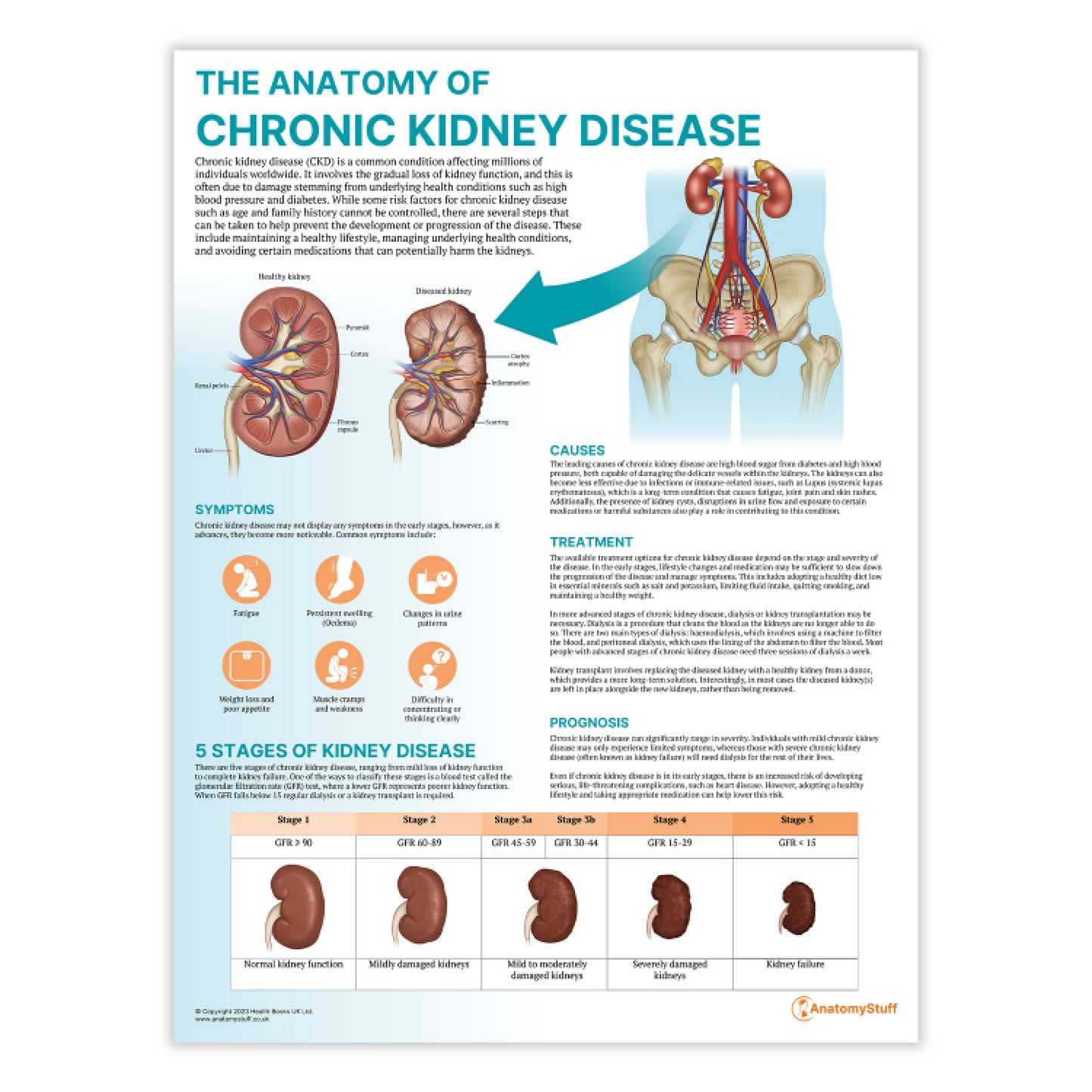 The Anatomy of Chronic Kidney Disease Chart / Poster