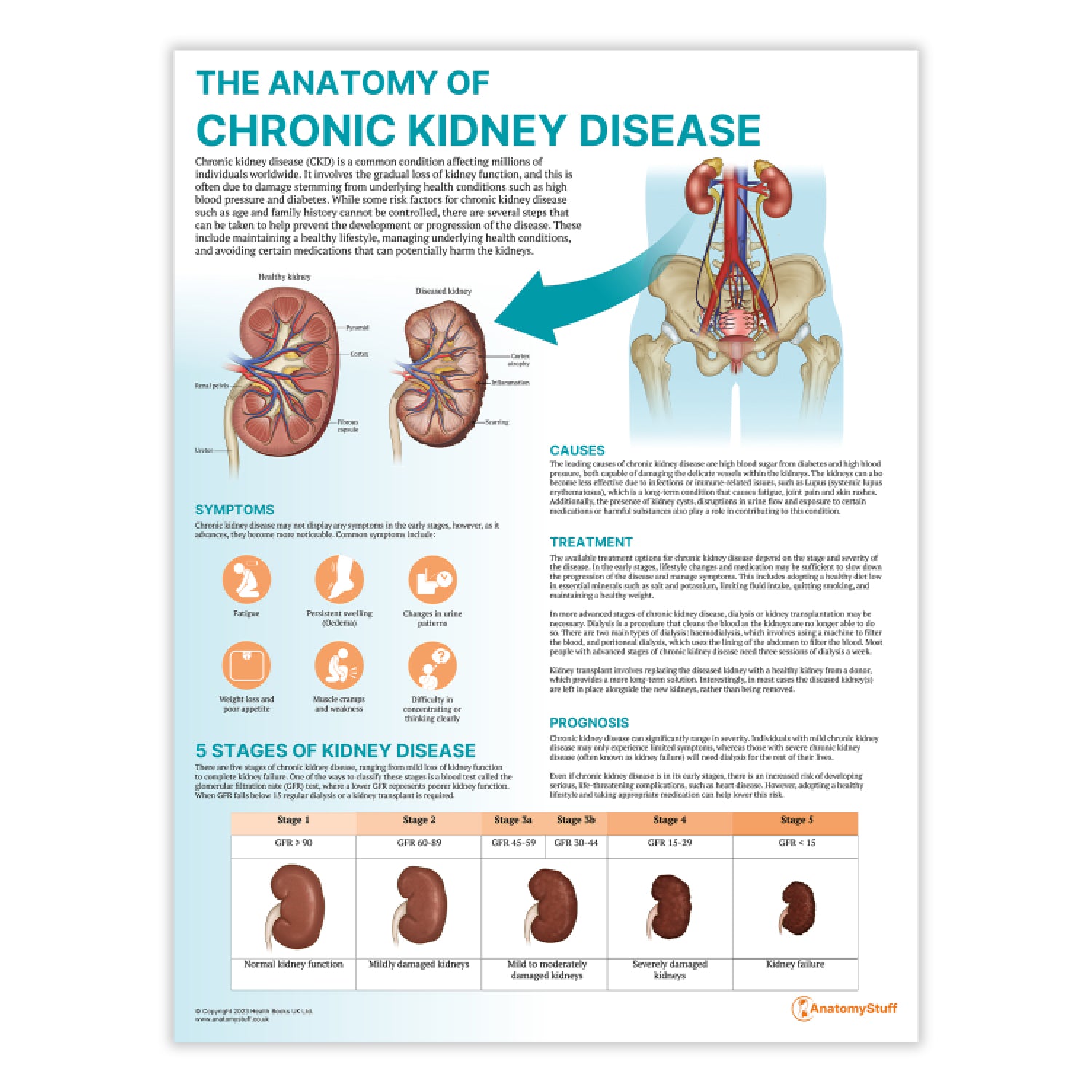 The Anatomy of Chronic Kidney Disease Chart / Poster