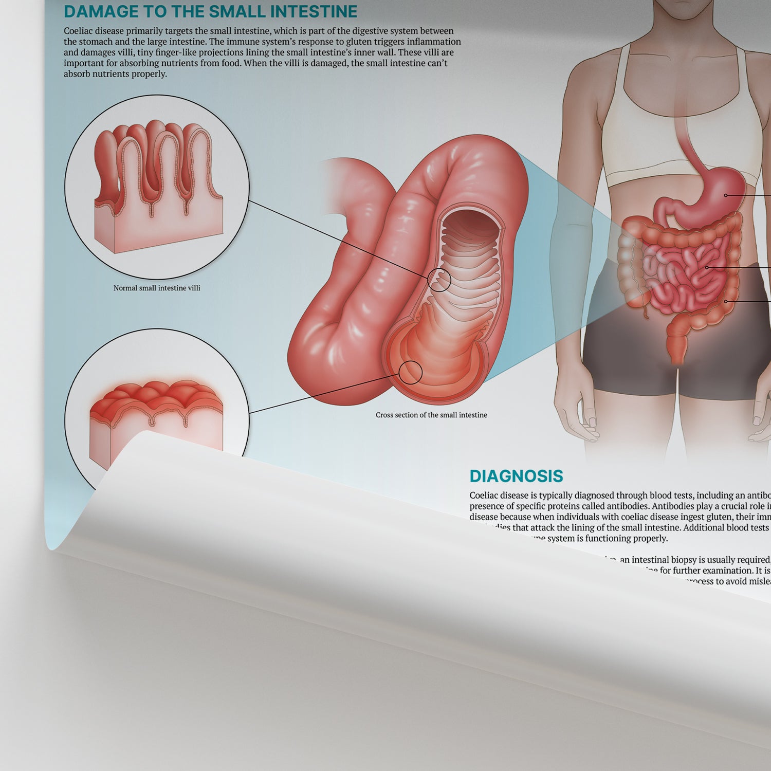 The Anatomy of Coeliac Disease Chart / Poster