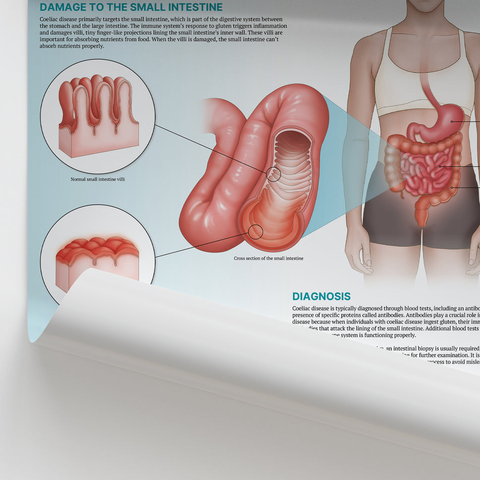 The Anatomy of Coeliac Disease Chart / Poster