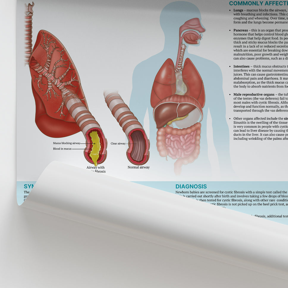 The Anatomy of Cystic Fibrosis Chart / Poster
