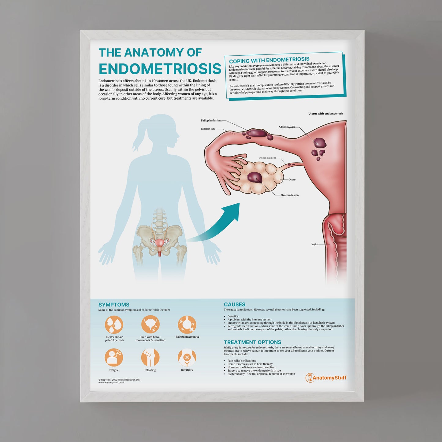 The Anatomy of Endometriosis Chart / Poster