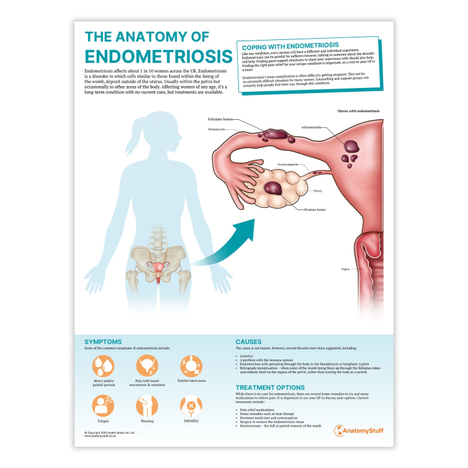 The Anatomy of Endometriosis Chart / Poster