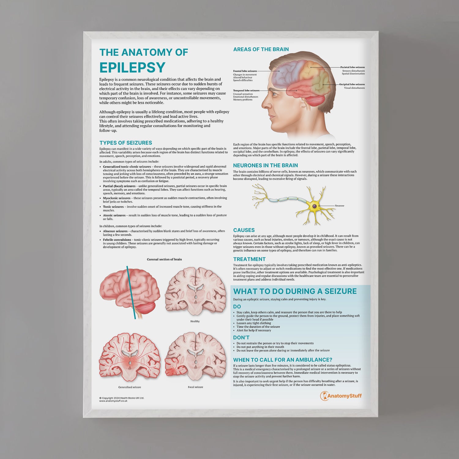 The Anatomy of Epilepsy Chart / Poster