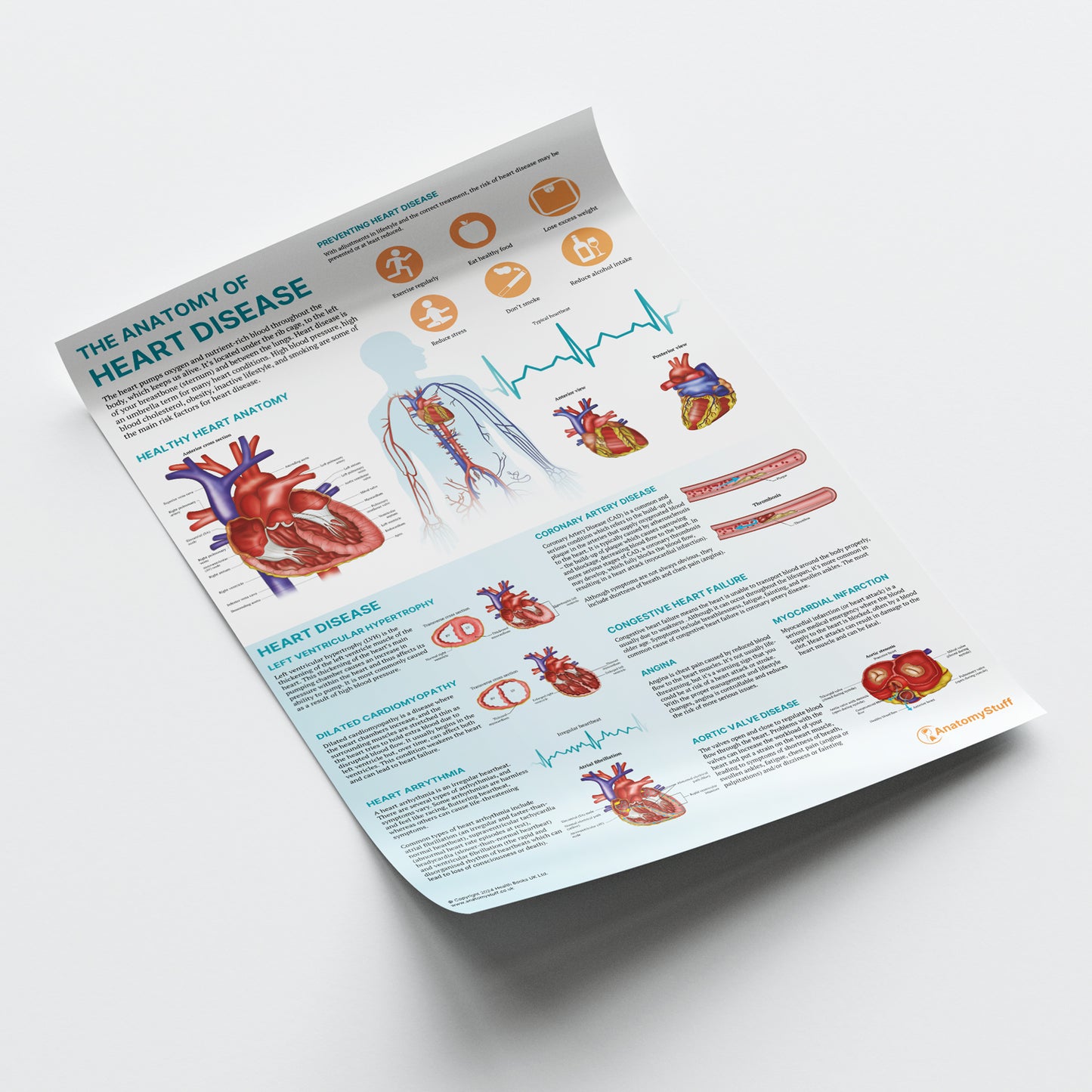 The Anatomy of Heart Disease Chart / Poster