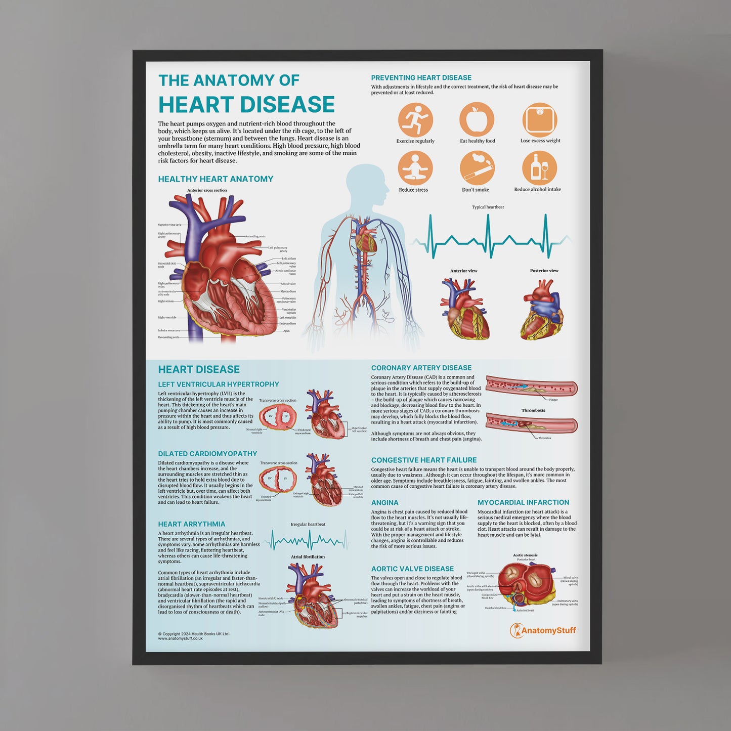 The Anatomy of Heart Disease Chart / Poster