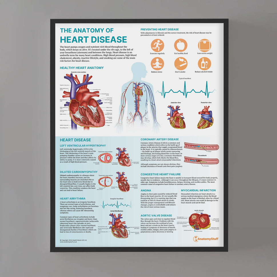 The Anatomy of Heart Disease Chart / Poster