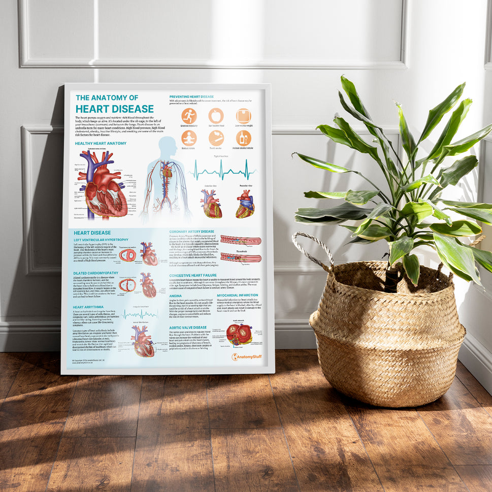 The Anatomy of Heart Disease Chart / Poster