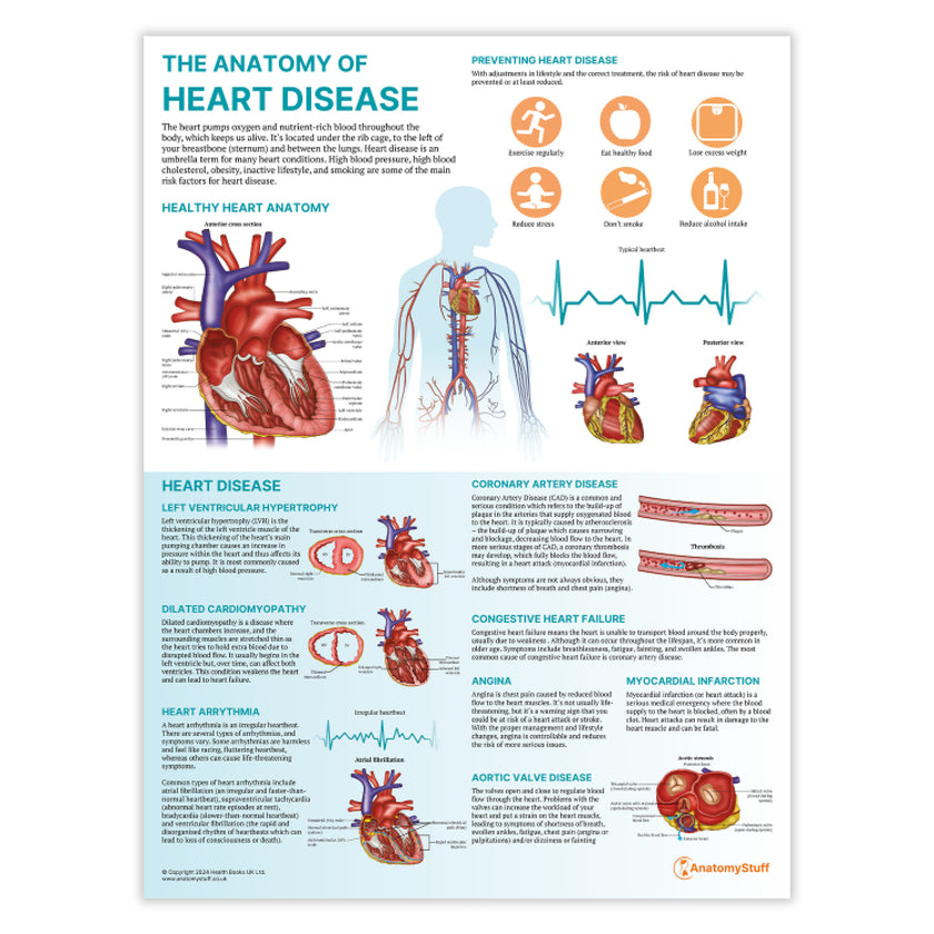 The Anatomy of Heart Disease Chart / Poster
