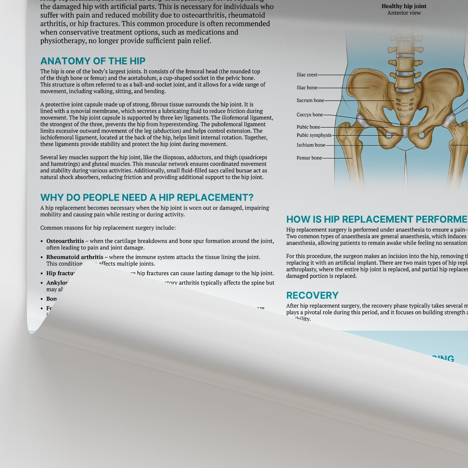 The Anatomy of Hip Replacement Chart / Poster
