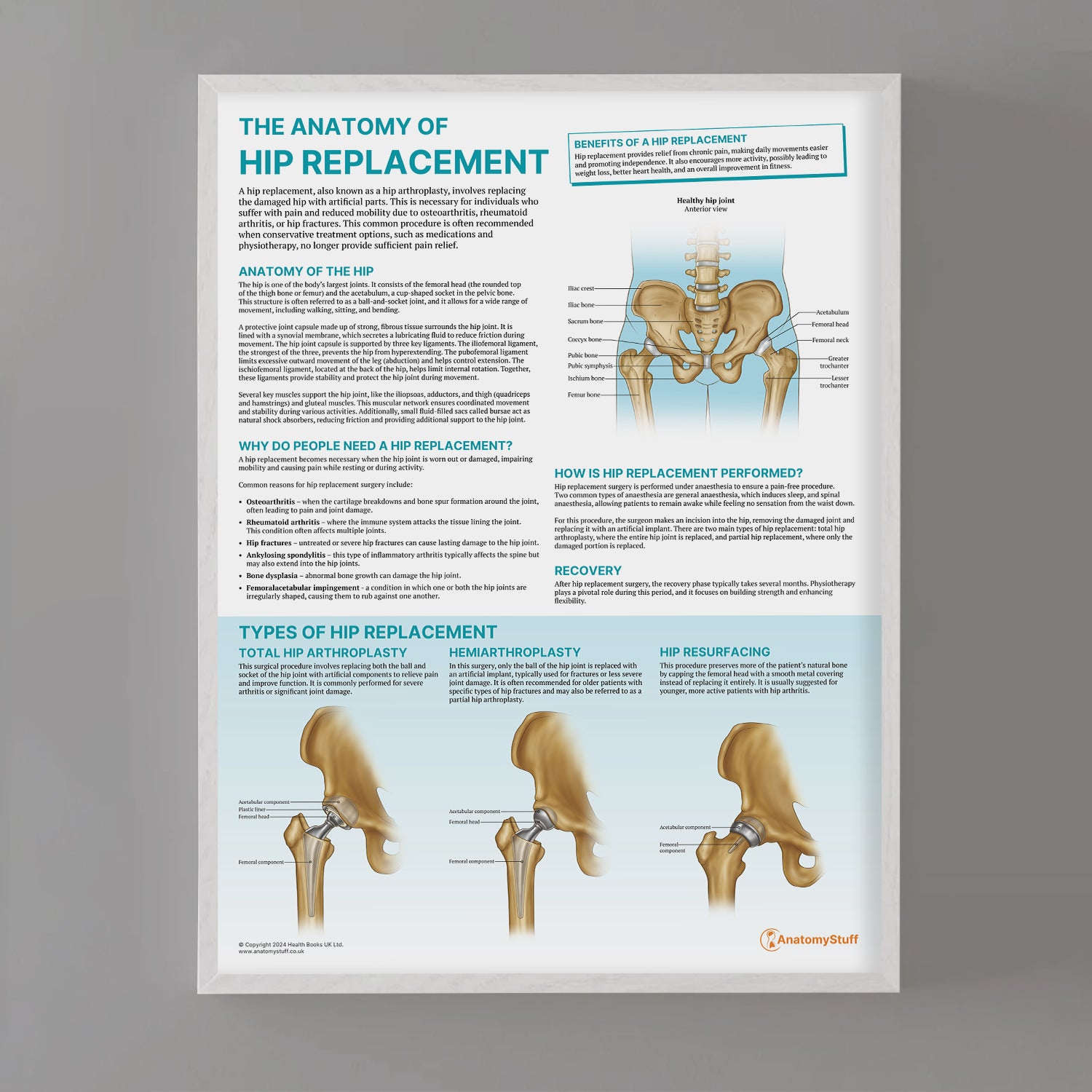 The Anatomy of Hip Replacement Chart / Poster