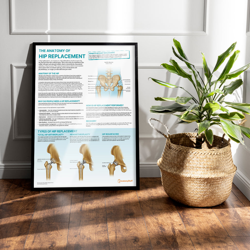 The Anatomy of Hip Replacement Chart / Poster