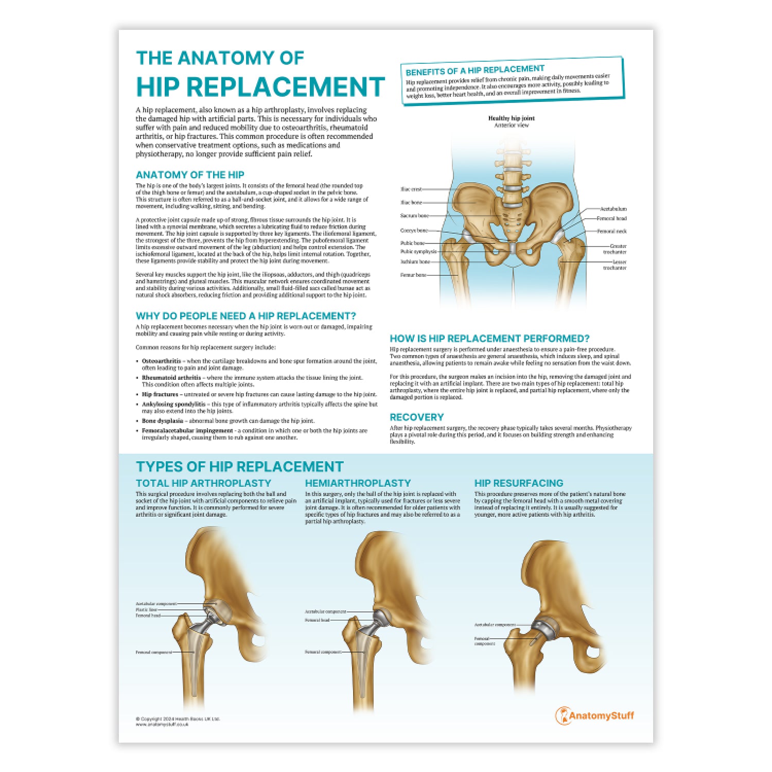 The Anatomy of Hip Replacement Chart / Poster