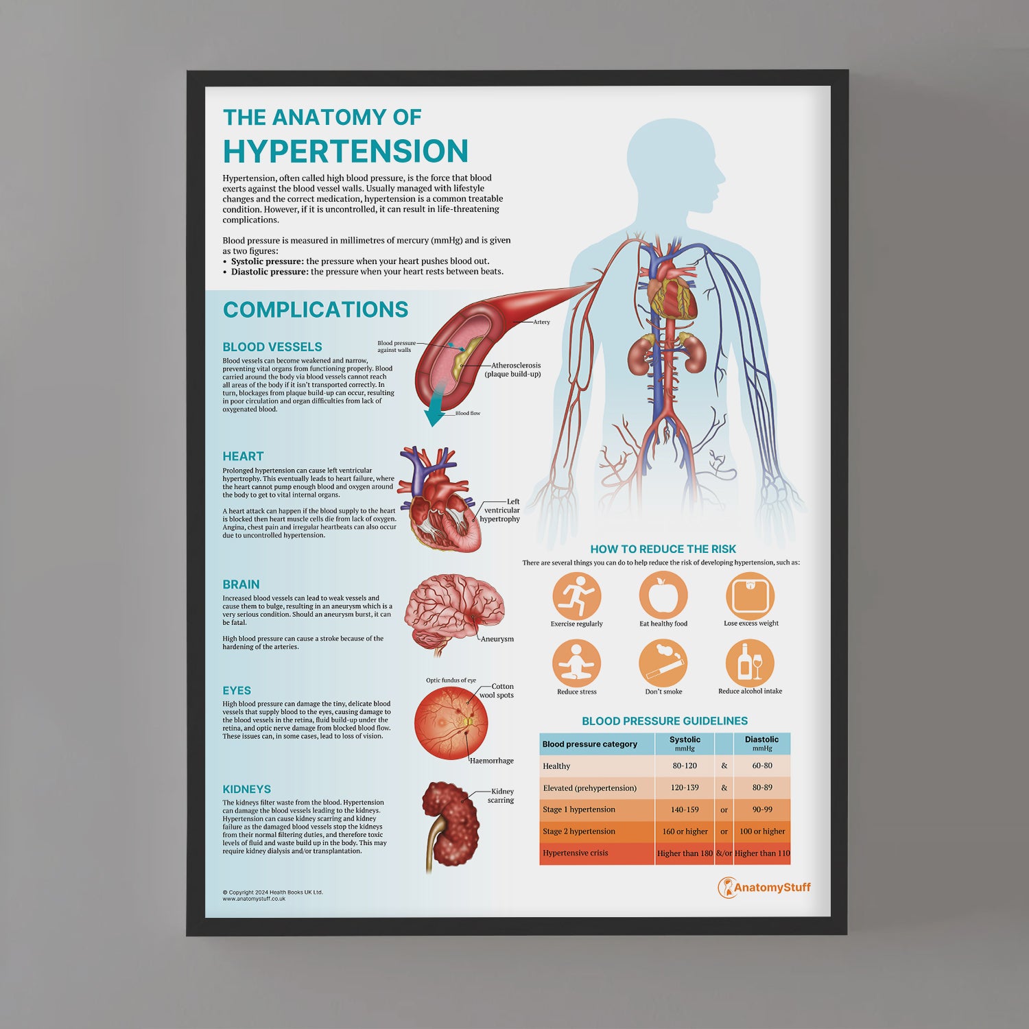 The Anatomy of Hypertension Chart / Poster