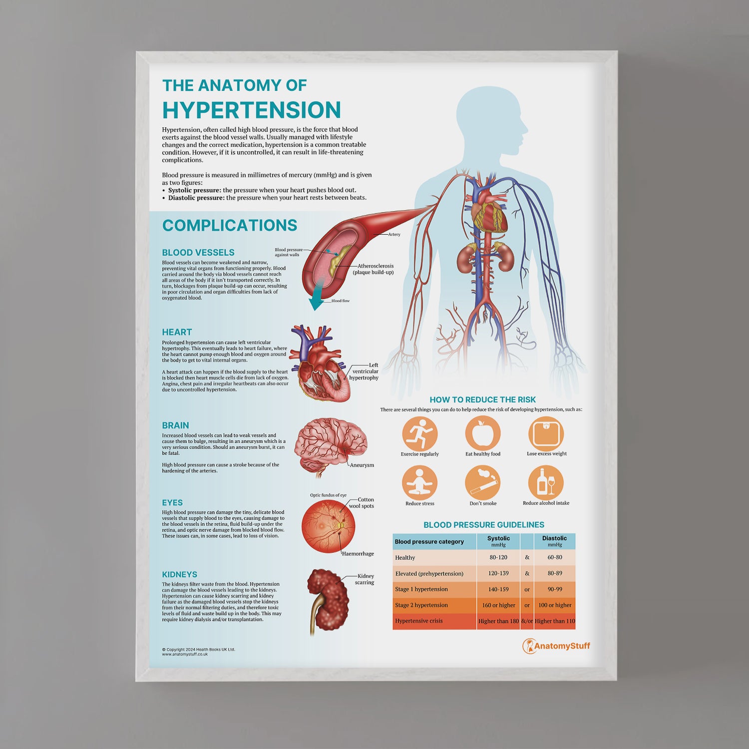 The Anatomy of Hypertension Chart / Poster