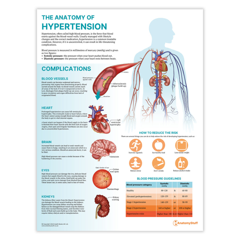 The Anatomy of Hypertension Chart / Poster