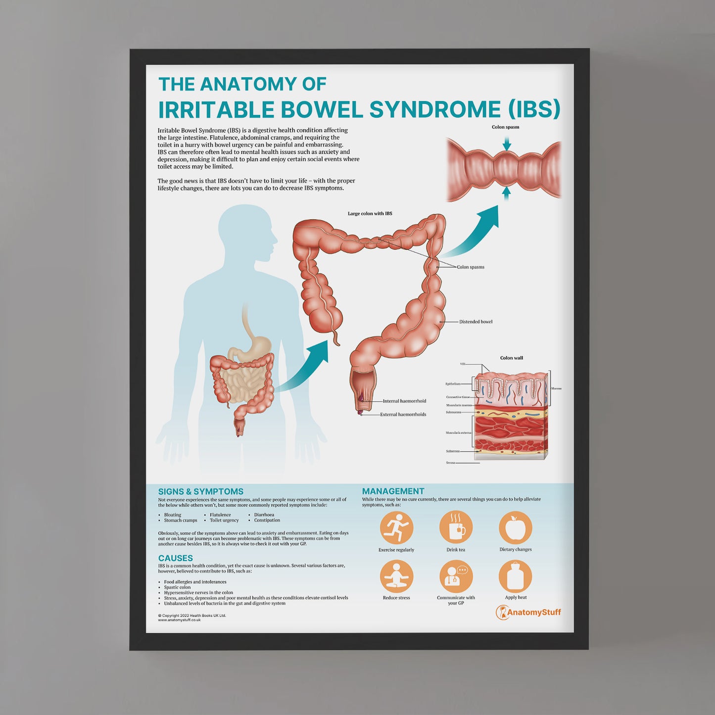 The Anatomy of Irritable Bowel Syndrome (IBS) Chart / Poster