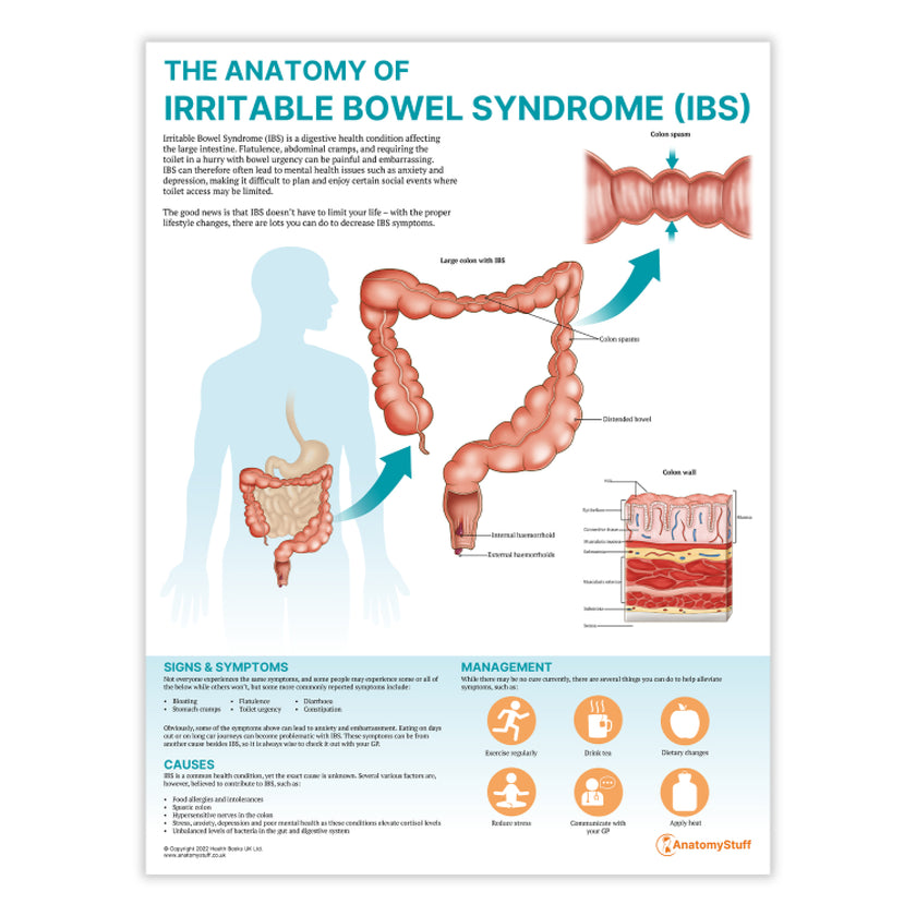 The Anatomy of Irritable Bowel Syndrome (IBS) Chart / Poster