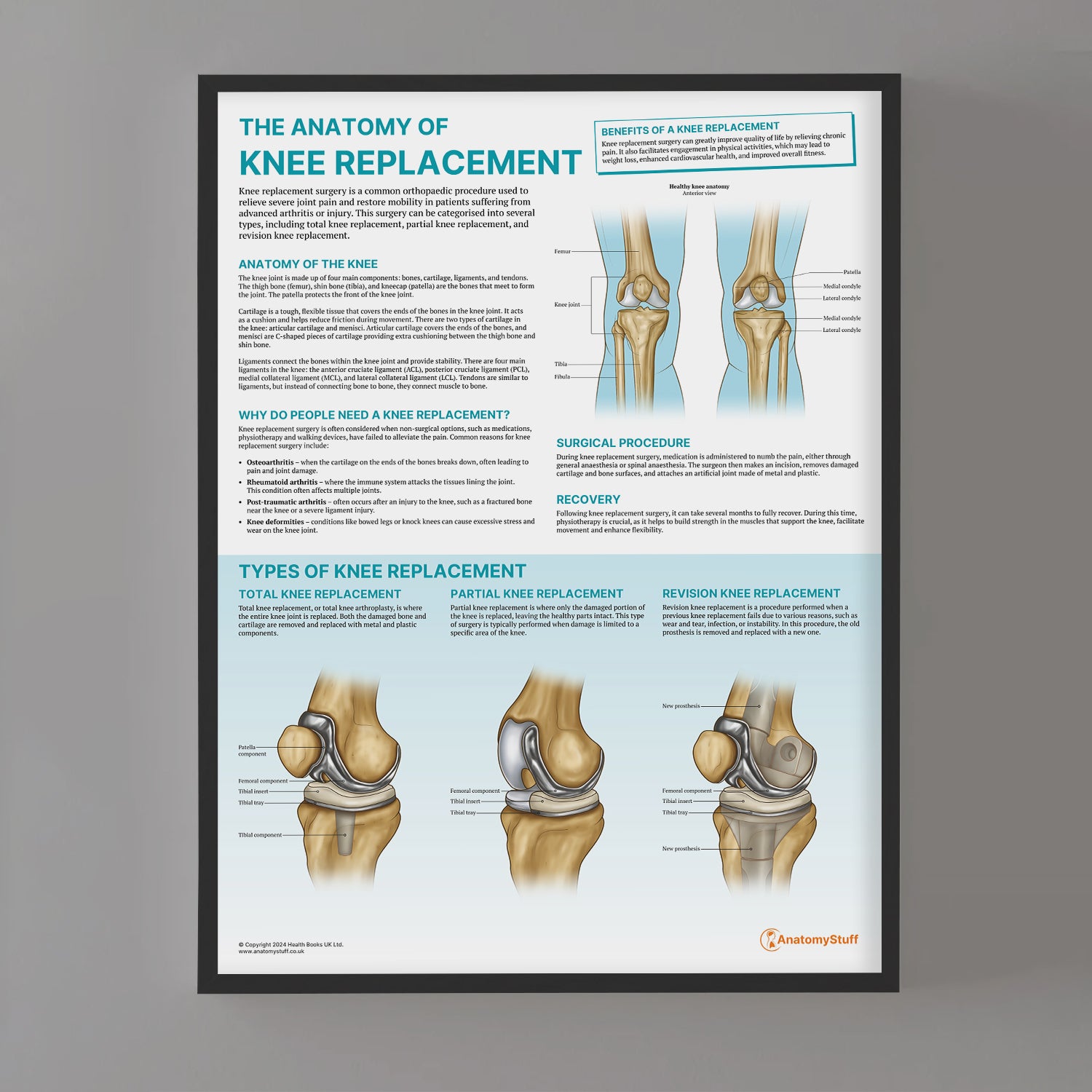The Anatomy of Knee Replacement Chart / Poster