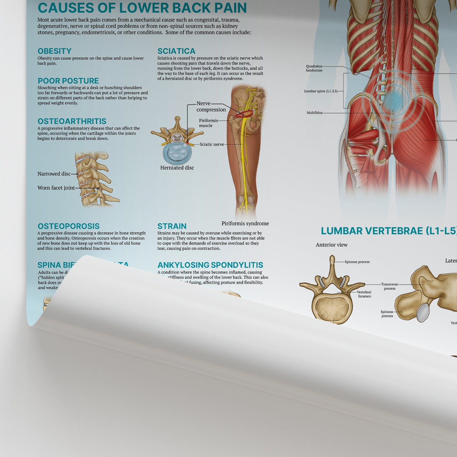 The Anatomy of Lower Back Pain Chart / Poster