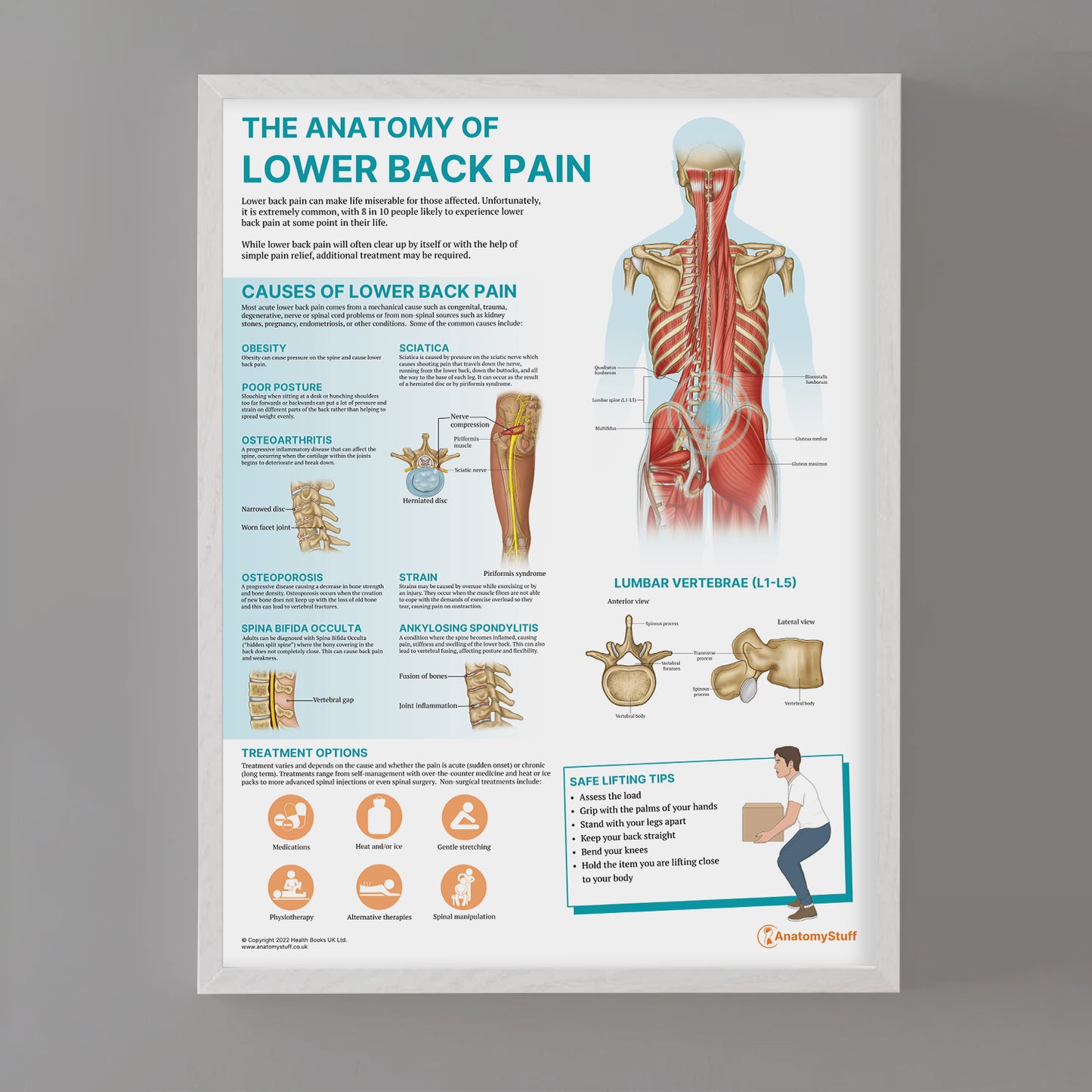 The Anatomy of Lower Back Pain Chart / Poster