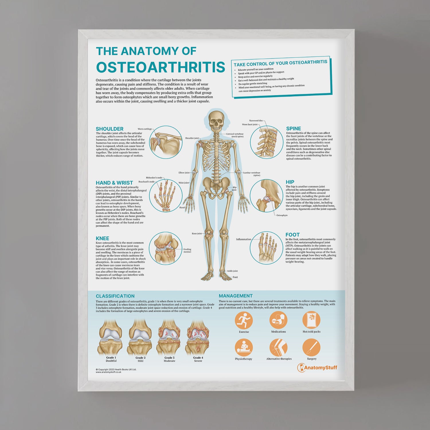 The Anatomy of Osteoarthritis Chart / Poster