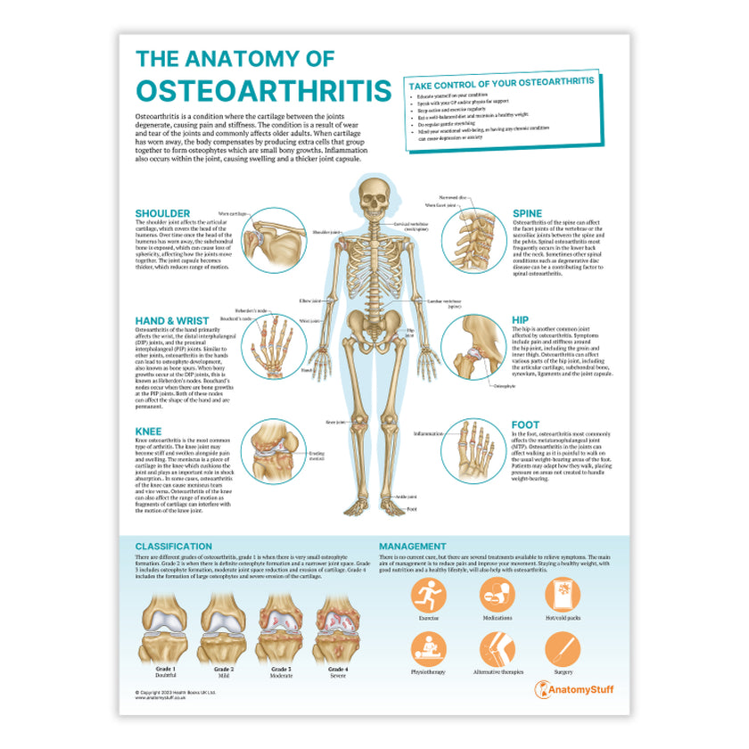 The Anatomy of Osteoarthritis Chart / Poster