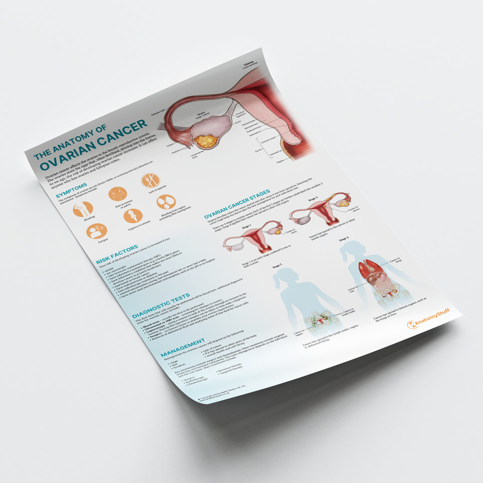 The Anatomy of Ovarian Cancer Chart / Poster