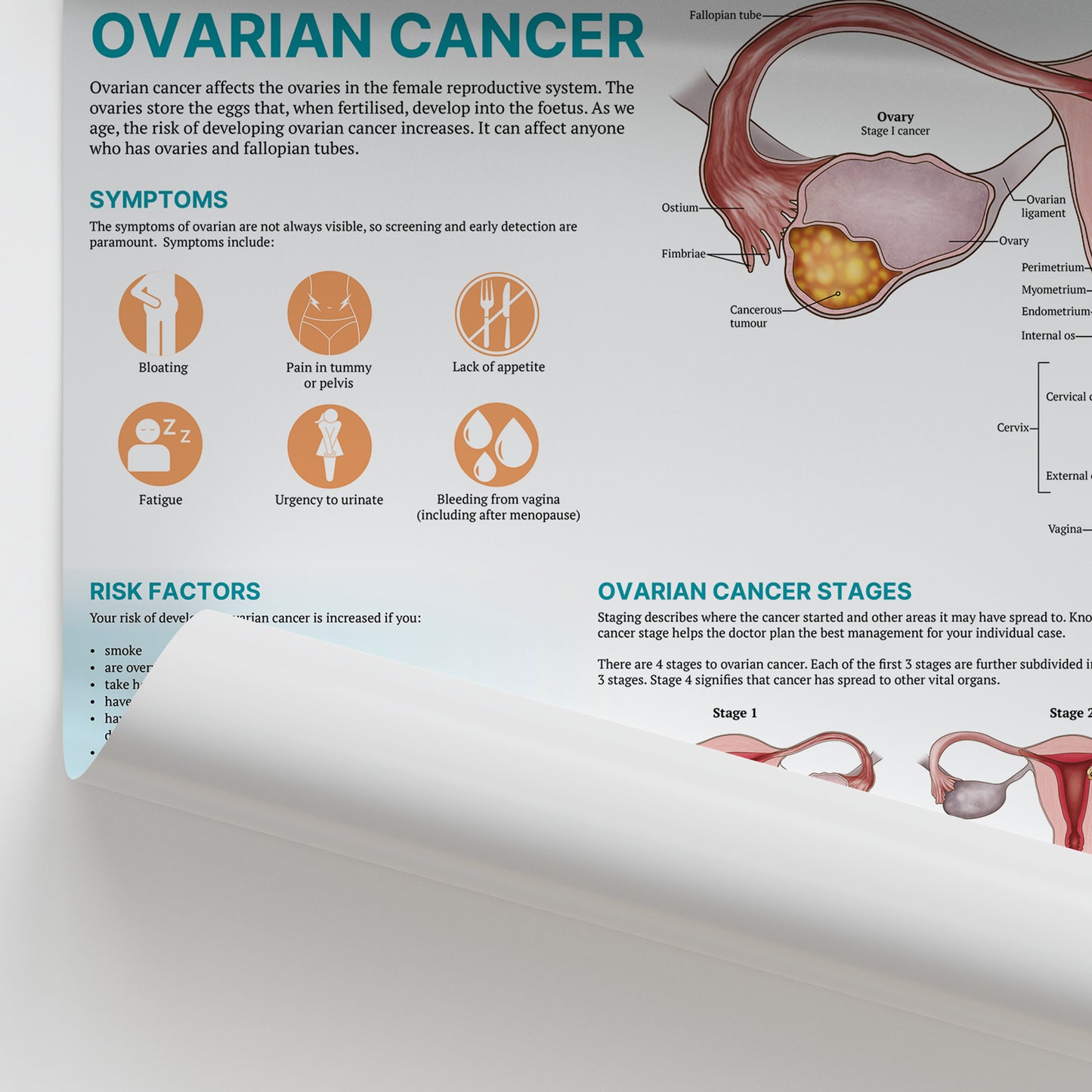 The Anatomy of Ovarian Cancer Chart / Poster