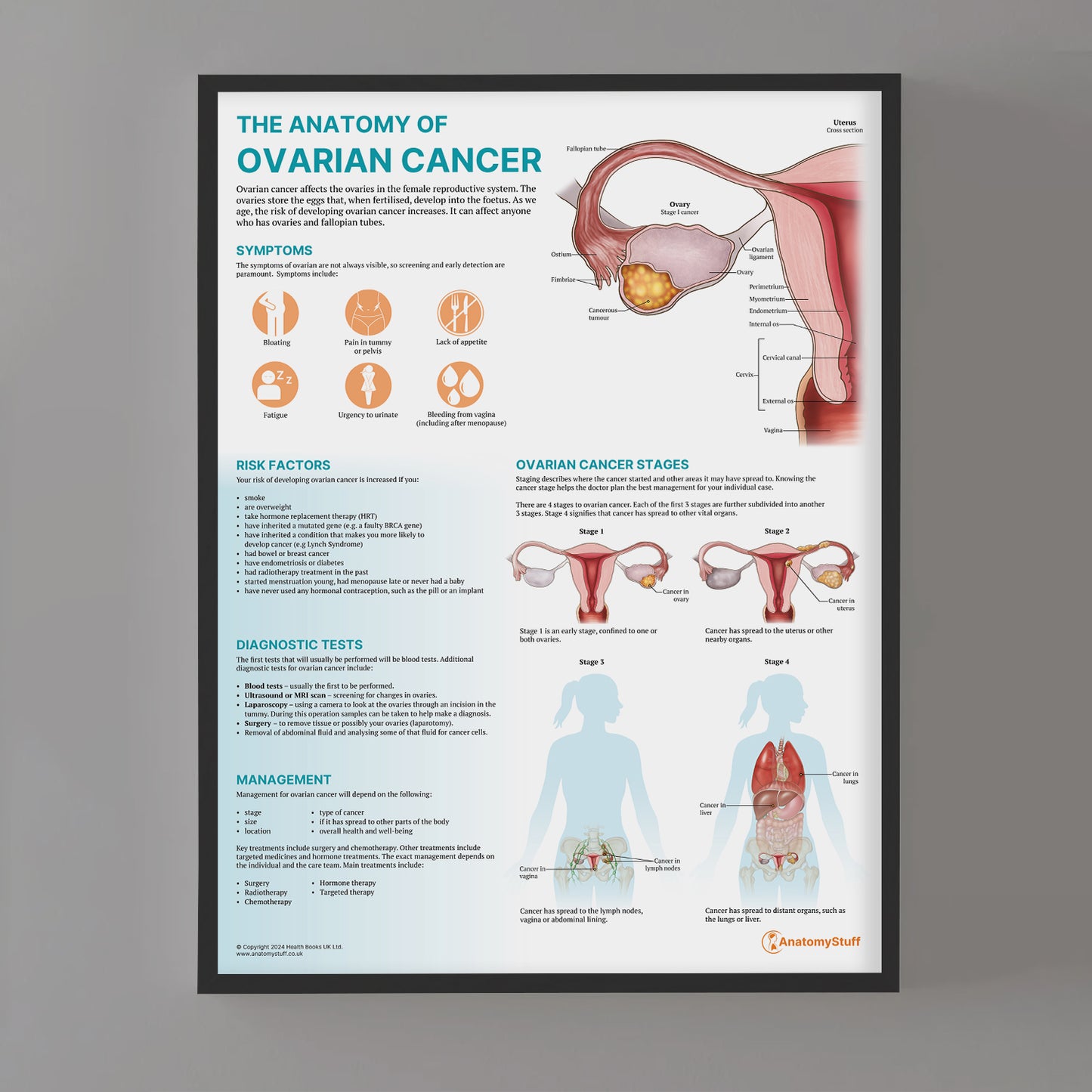 The Anatomy of Ovarian Cancer Chart / Poster