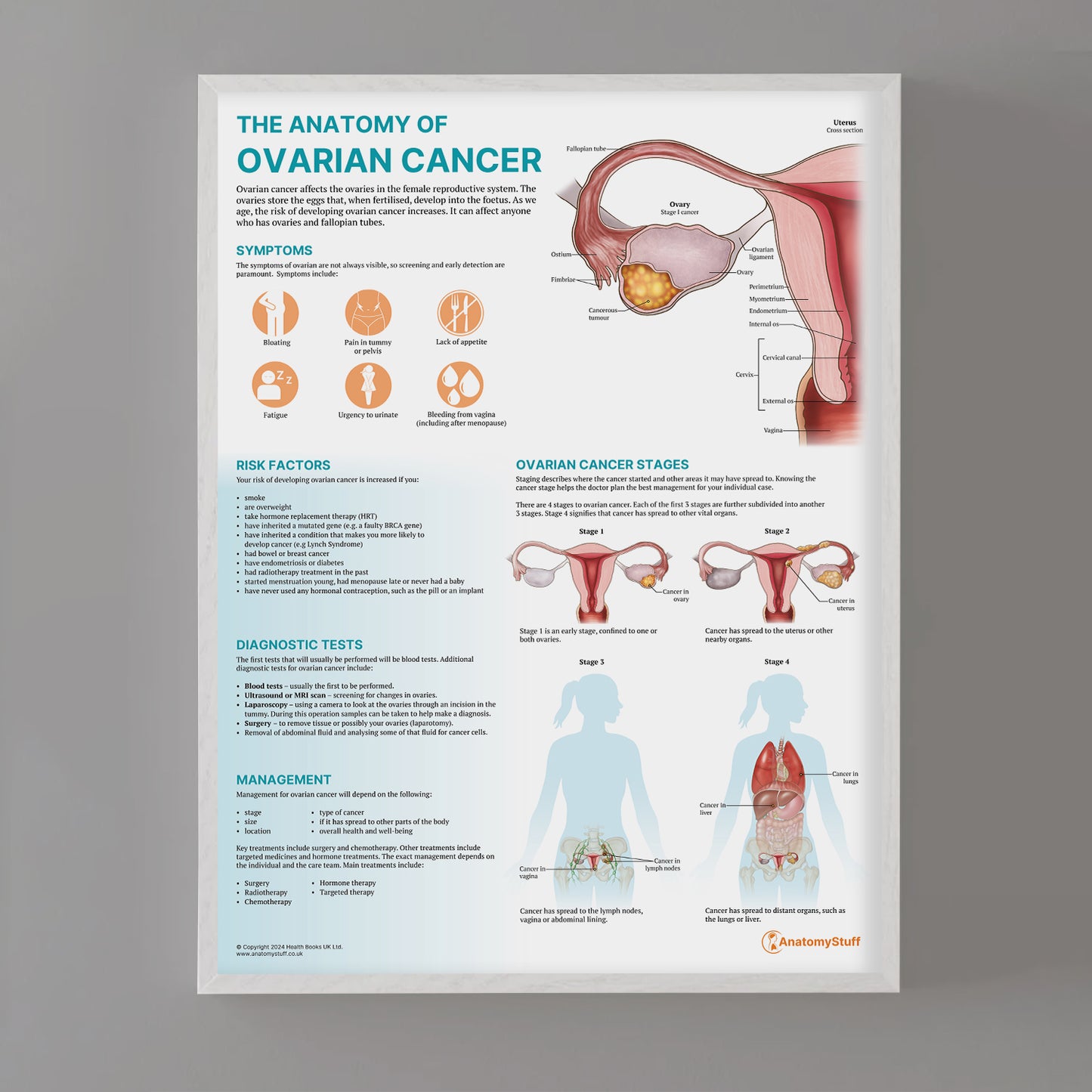 The Anatomy of Ovarian Cancer Chart / Poster
