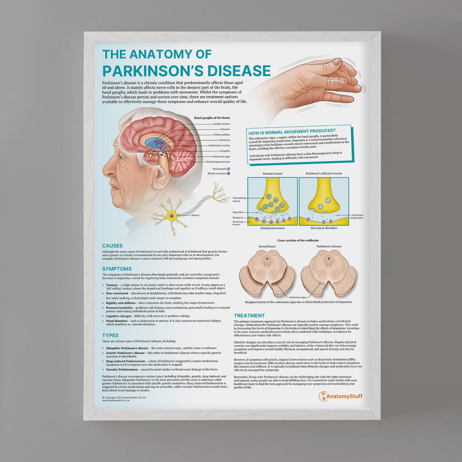The Anatomy of Parkinson's Disease Chart / Poster