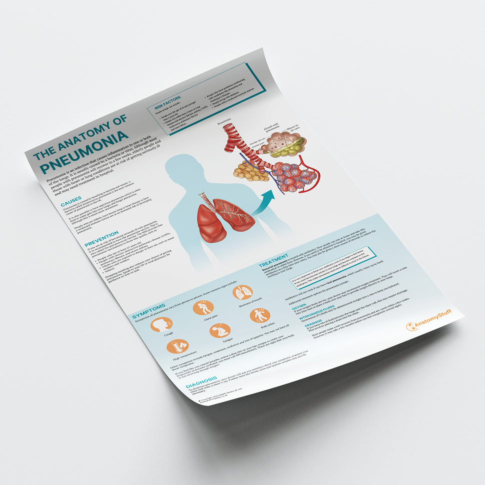 The Anatomy of Pneumonia  Chart / Poster