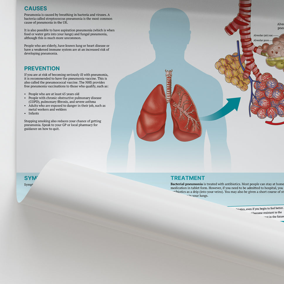 The Anatomy of Pneumonia  Chart / Poster