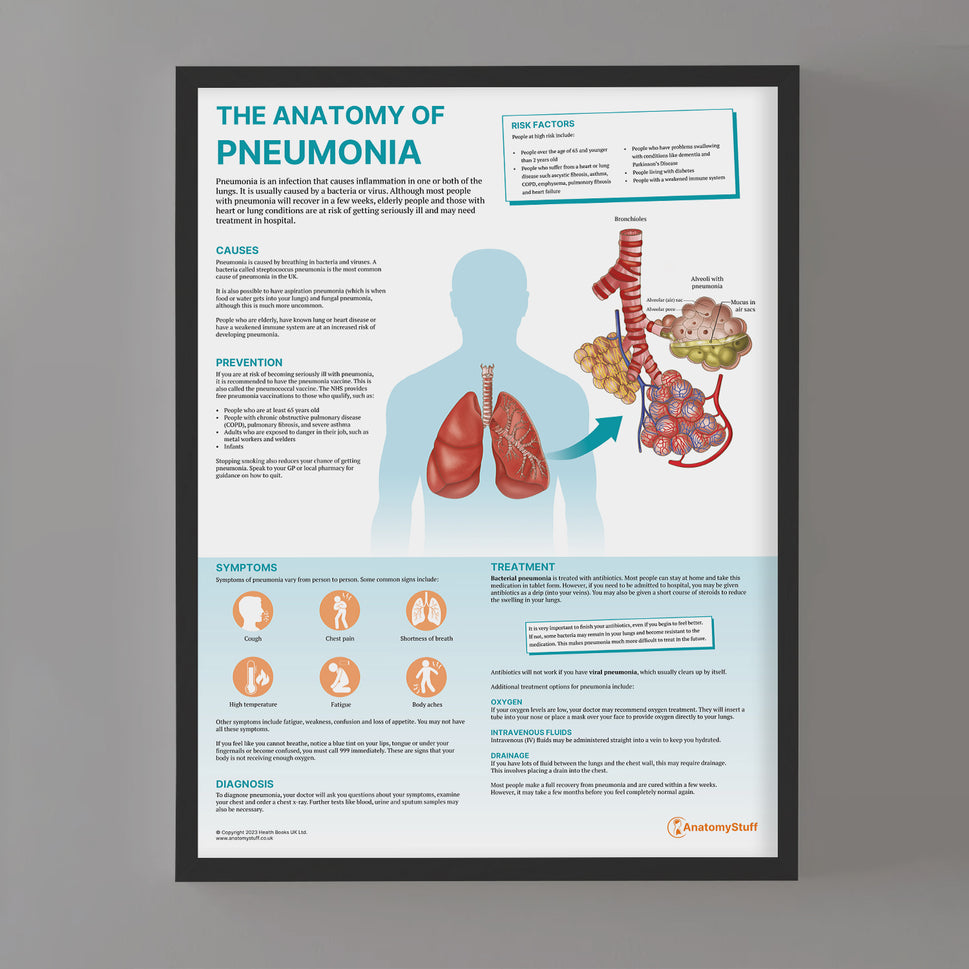 The Anatomy of Pneumonia  Chart / Poster