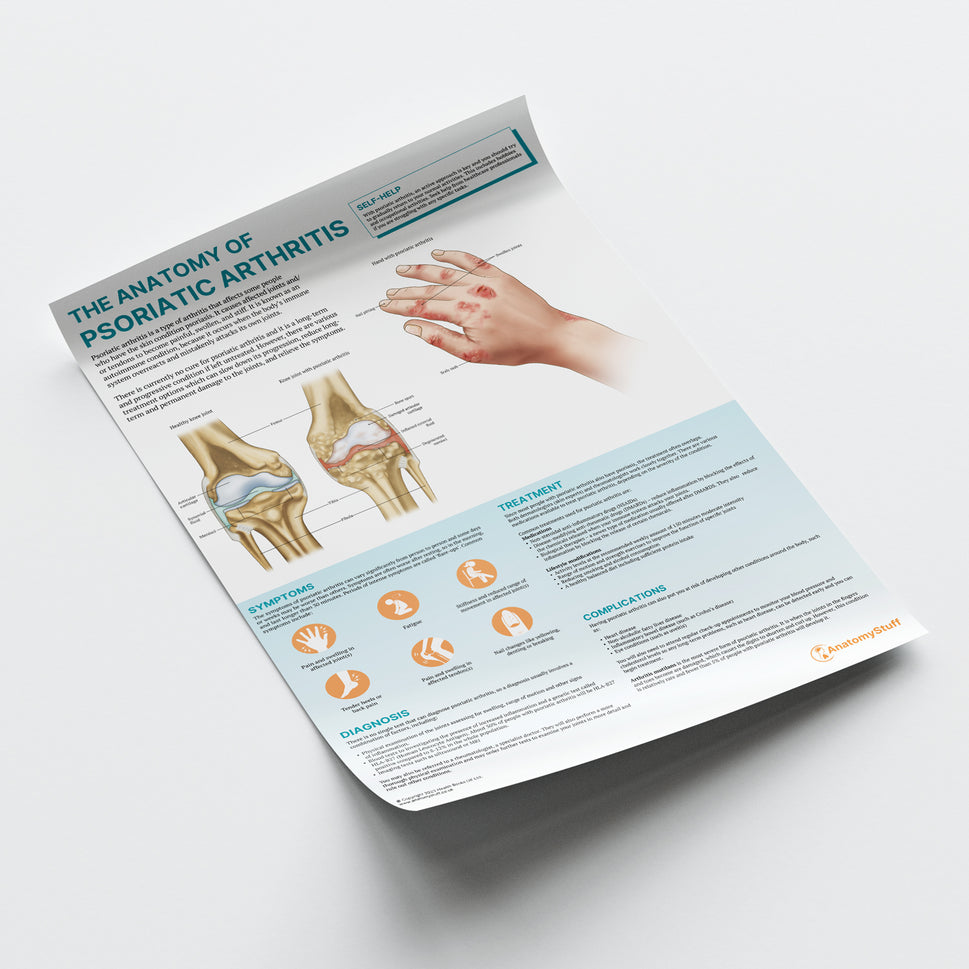 The Anatomy of Psoriatic Arthritis Chart / Poster