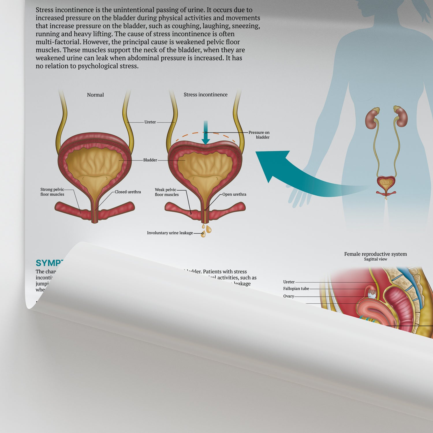 The Anatomy of Stress Incontinence Chart / Poster
