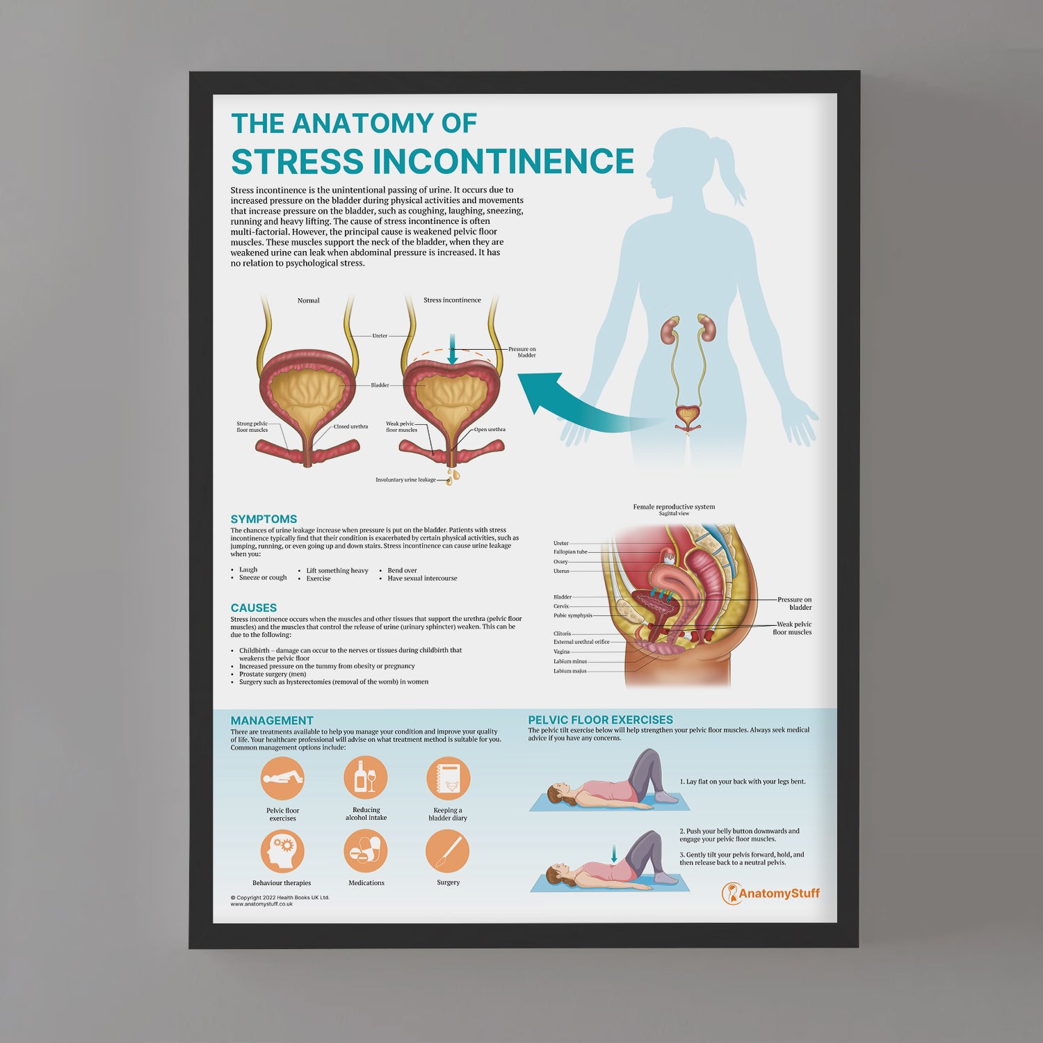 The Anatomy of Stress Incontinence Chart / Poster