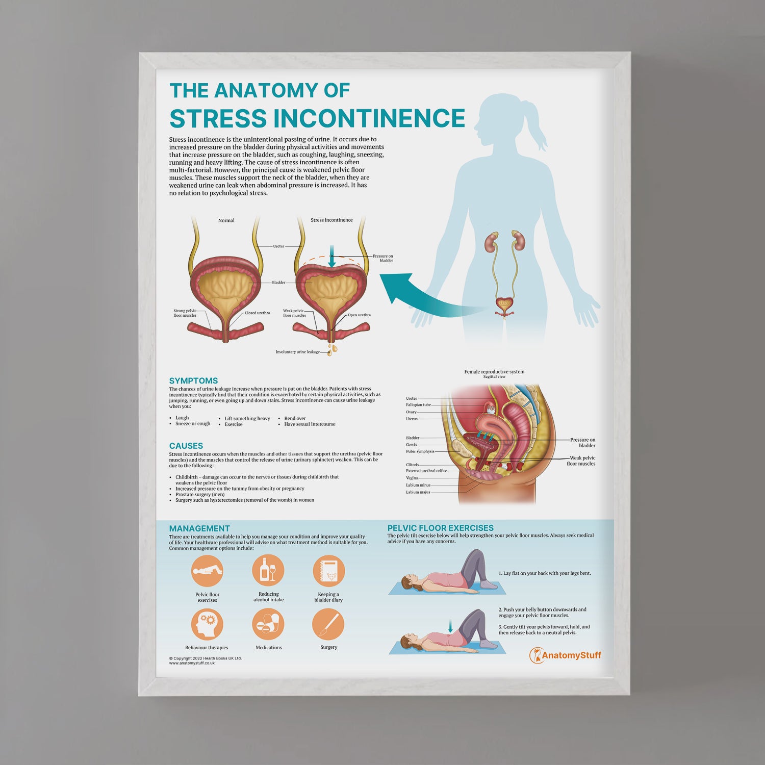 The Anatomy of Stress Incontinence Chart / Poster