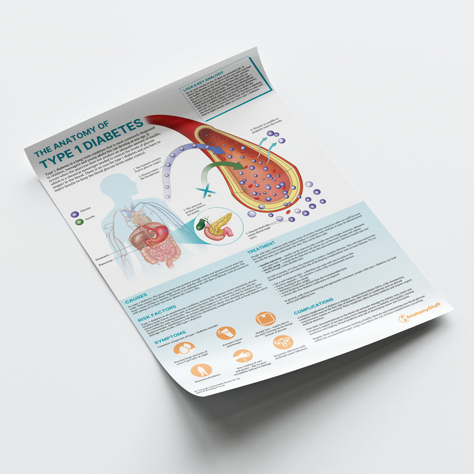 The Anatomy of Type 1 Diabetes Chart / Poster