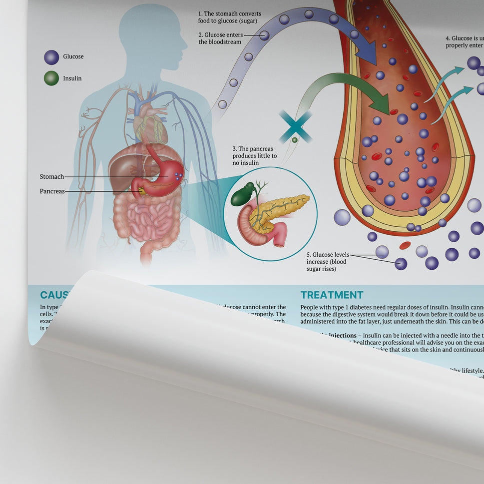The Anatomy of Type 1 Diabetes Chart / Poster