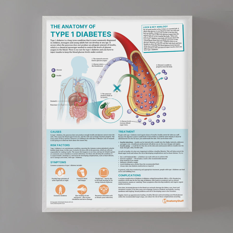 The Anatomy of Type 1 Diabetes Chart / Poster