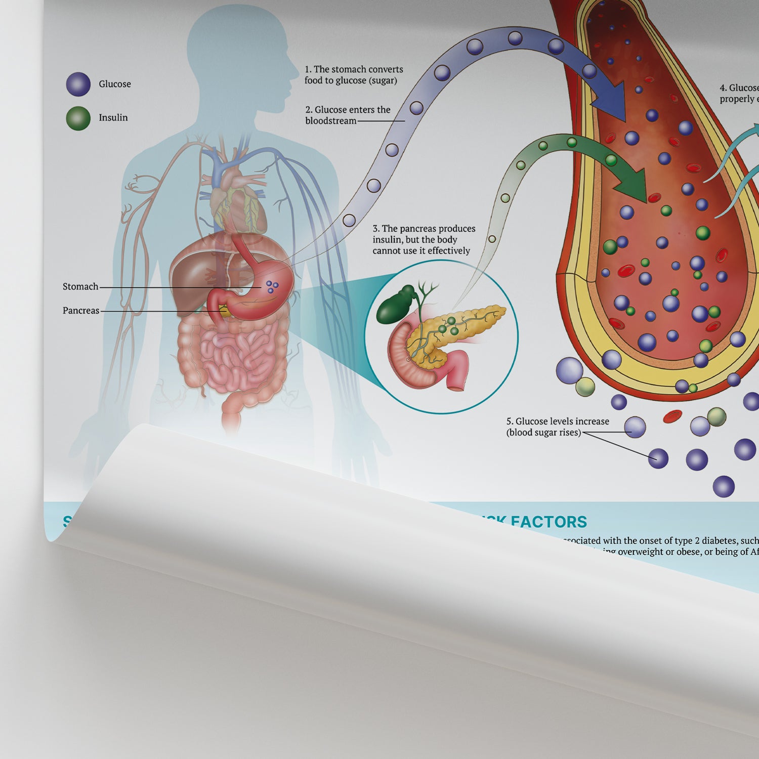 The Anatomy of Type 2 Diabetes Chart / Poster