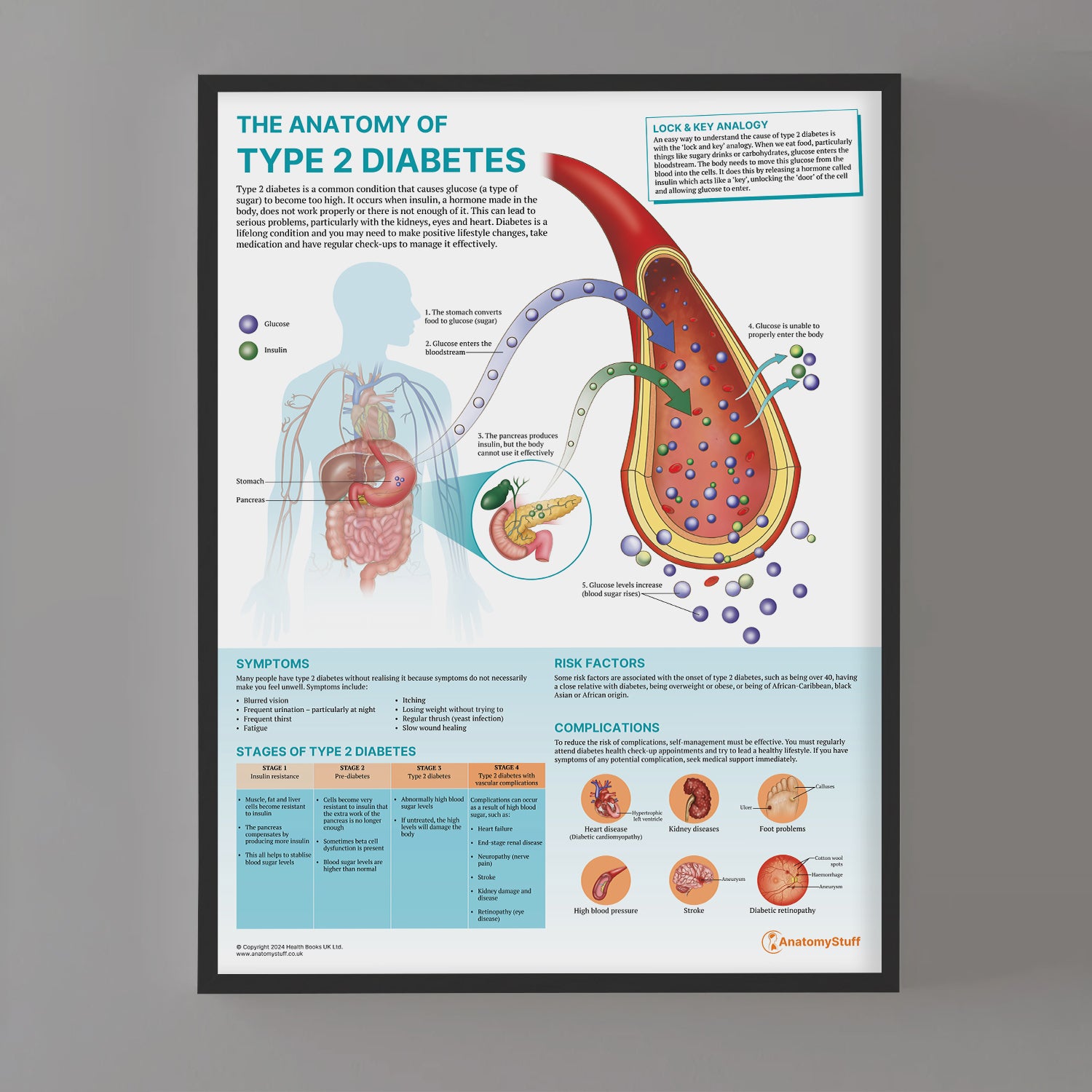 The Anatomy of Type 2 Diabetes Chart / Poster