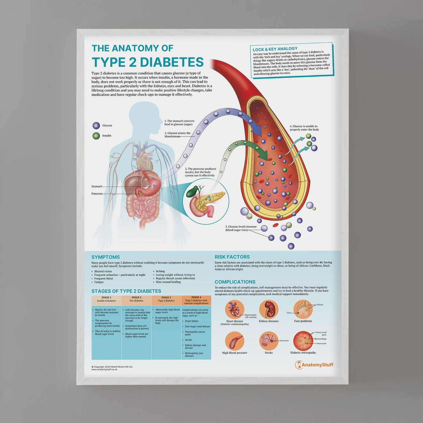The Anatomy of Type 2 Diabetes Chart / Poster